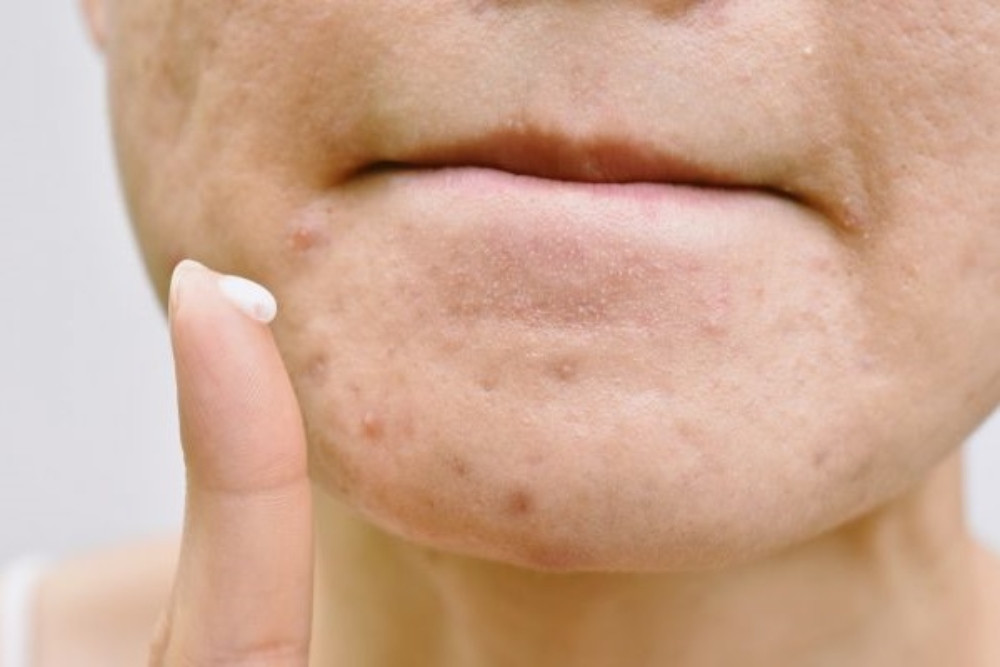 Dùng kem trị mụn giúp làm sạch mụn hiệu quả