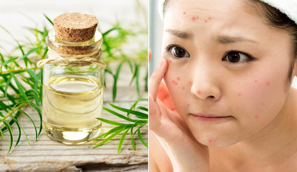 Dùng tinh dầu tràm trà để trị mụn ẩn hiệu quả