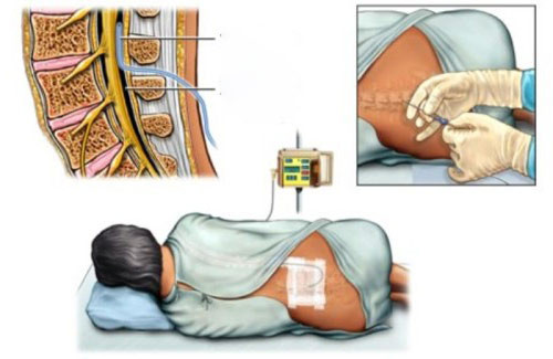 Sinh nở không đau bằng phương pháp gây tê ngoài màng cứng