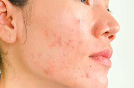 Purging là gì? Nên làm gì khi da bị purging?