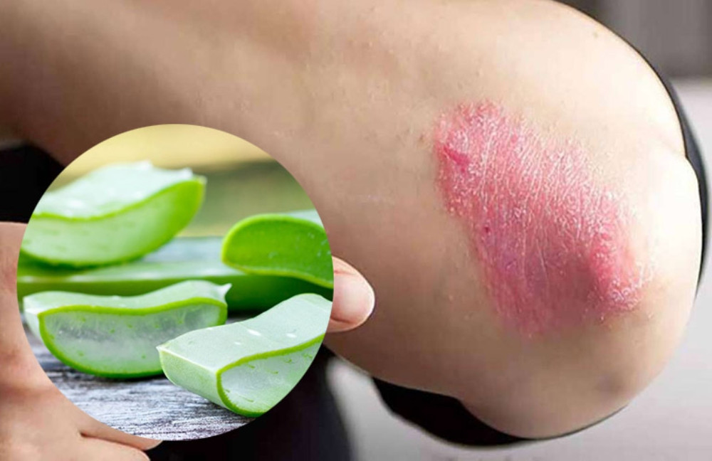 Hỗ trợ giảm ngứa, khô khi bị chàm