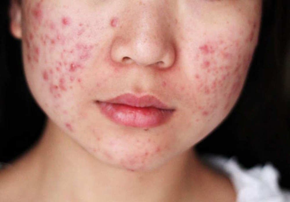 Hormone thay đổi là nguyên nhân chính dẫn đến tình trạng nổi mụn của mẹ bầu