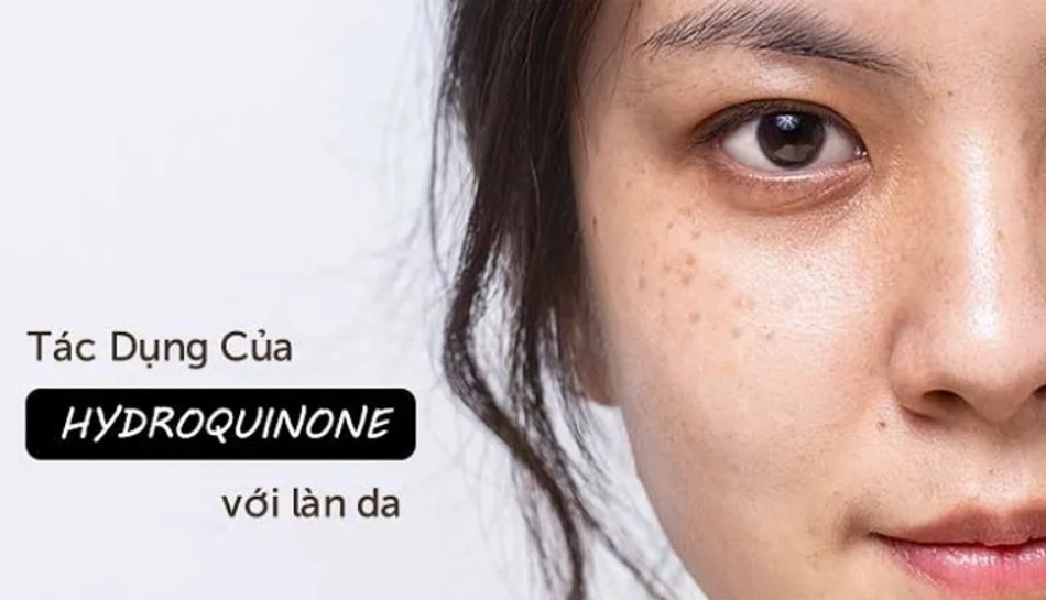 Hydroquinone Có Thể Gây Nguy Cơ Ngộ Độc