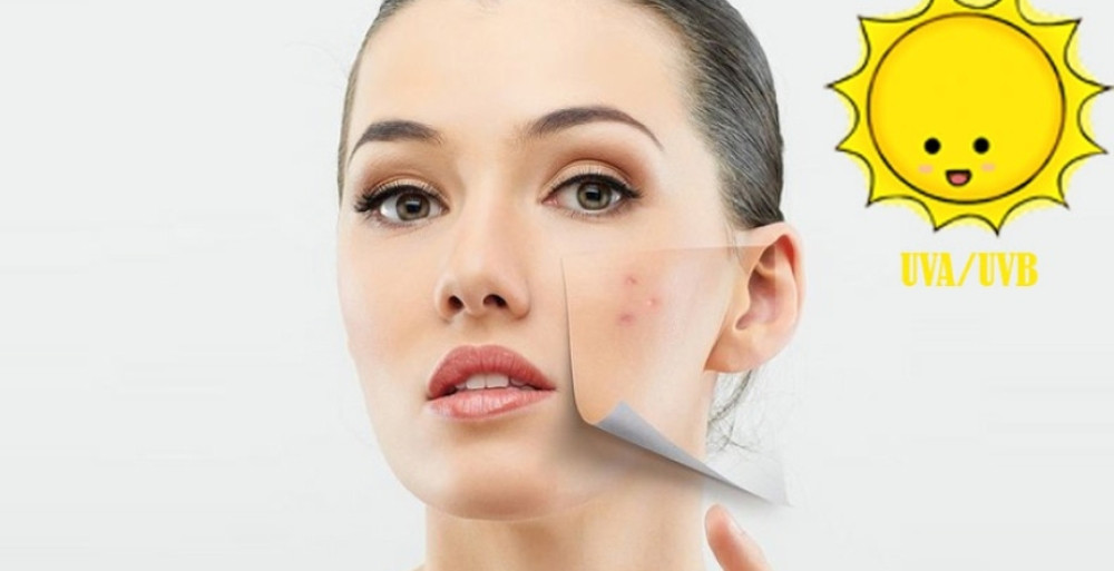 Kem chống nắng giúp ngăn ngừa mụn