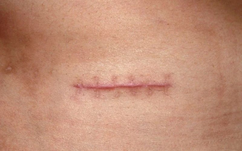 Khâu vết thương sâu giúp ngăn ngừa nhiễm trùng
