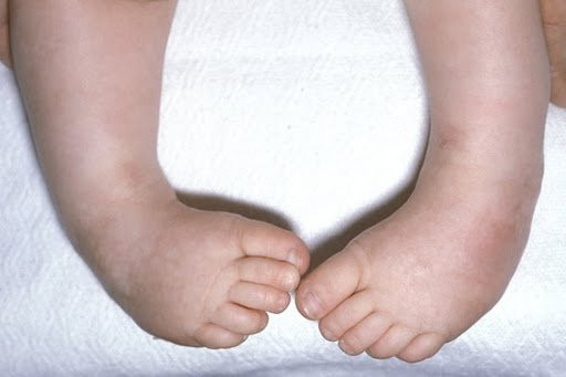 Nguyên nhân khoèo chân ở trẻ sơ sinh