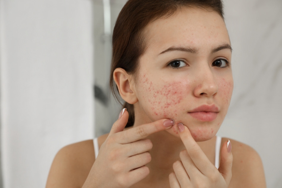 Không sử dụng kem chống nắng cho da mụn