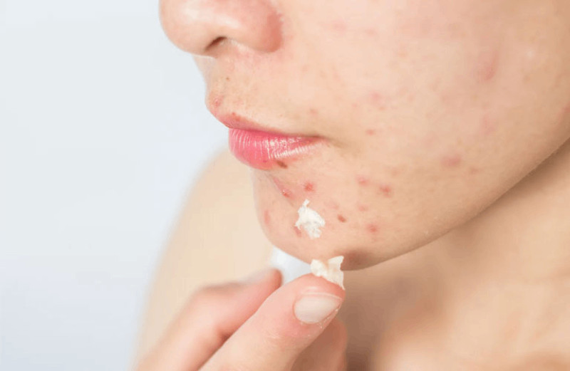 Kiên trì sử dụng kem đặc trị sẽ giúp cải thiện tình trạng da nhanh chóng.