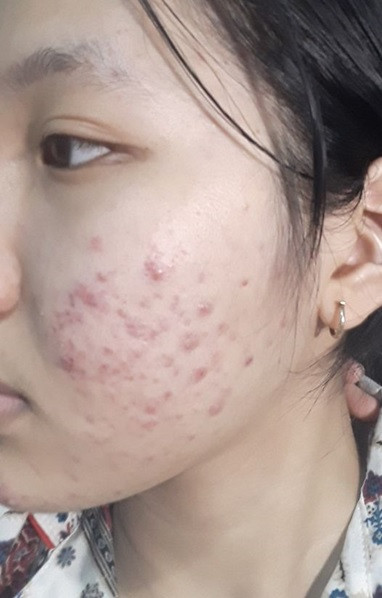 Klenzit C không hiệu quả