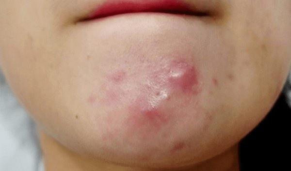 Klenzit C tác dụng phụ