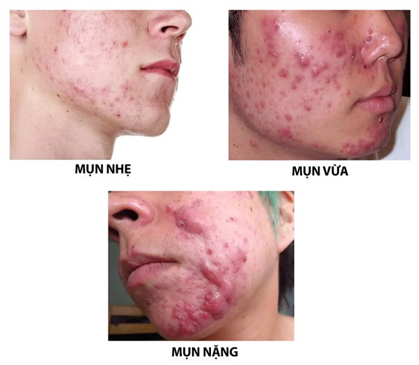 Klenzit C vi khuẩn