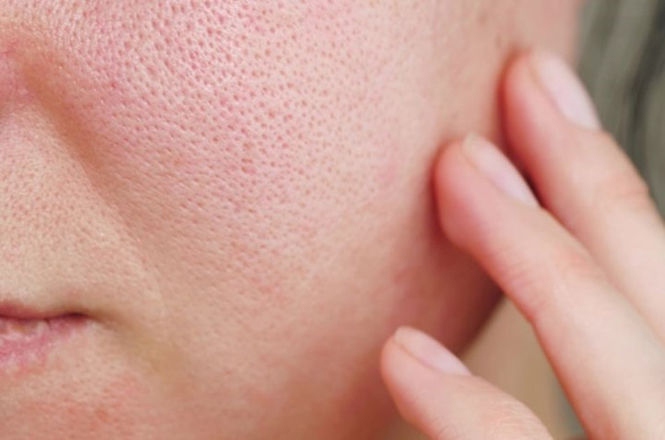 Top 14 mặt nạ giúp se khít lỗ chân lông hiệu quả