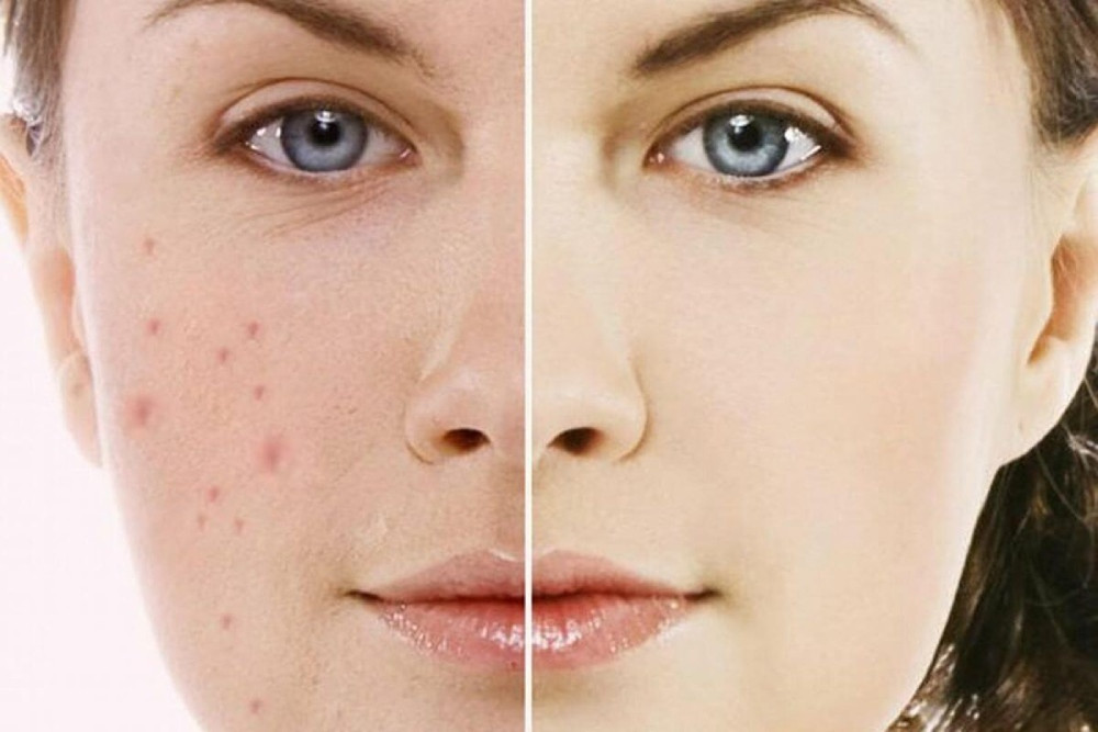 Làm mờ các vết thâm nám hiệu quả