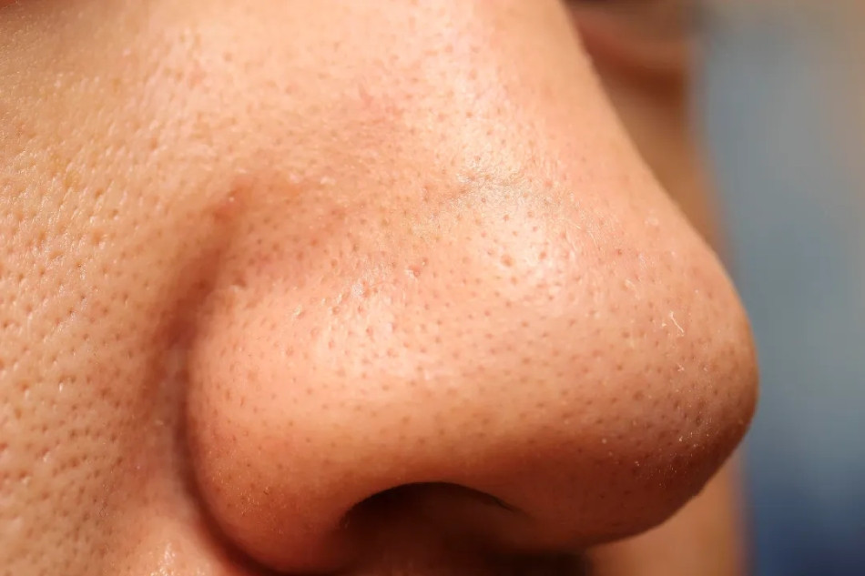 Làm sạch sỏi bã nhờn với Retinoids