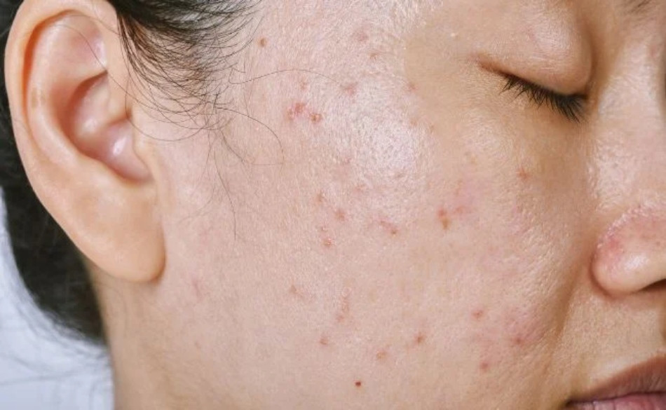 Làn da dầu mụn rất khó chăm sóc và dễ gặp các vấn đề về mụn