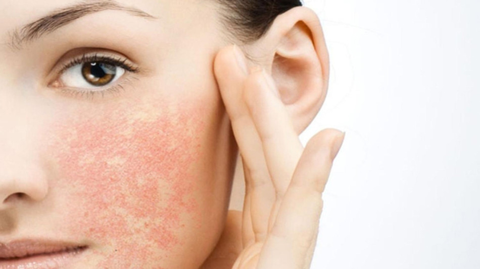 Làn da nhạy cảm dễ gặp tình trạng kích ứng