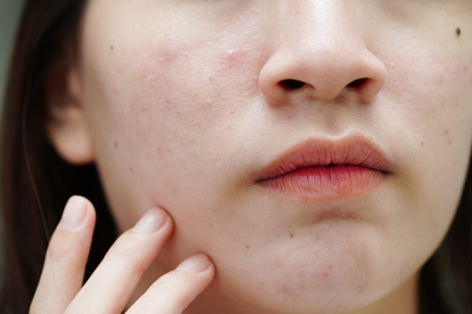 Lý do cần sử dụng sữa rửa mặt dành riêng cho da dầu mụn nhạy cảm
