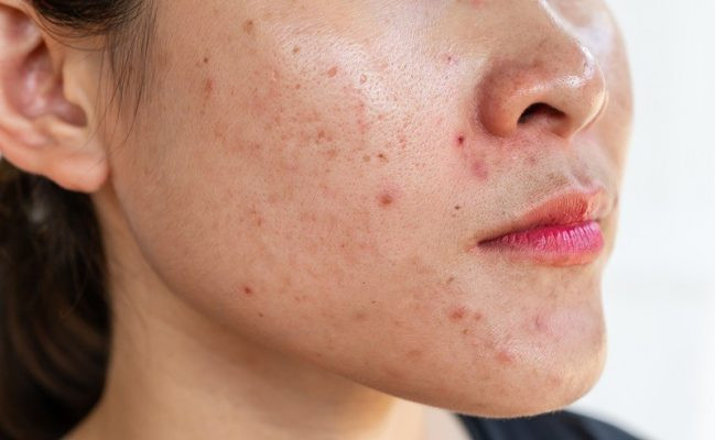 Lý do phục hồi da