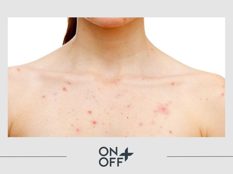 Mặc áo ngực quá chật gây kích ứng da, nổi mụn