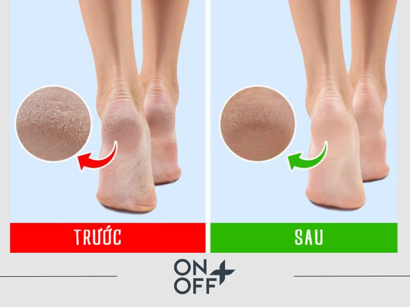 Mang vớ khi ngủ là một cách đơn giản để ngăn ngừa tình trạng nứt nẻ gót chân