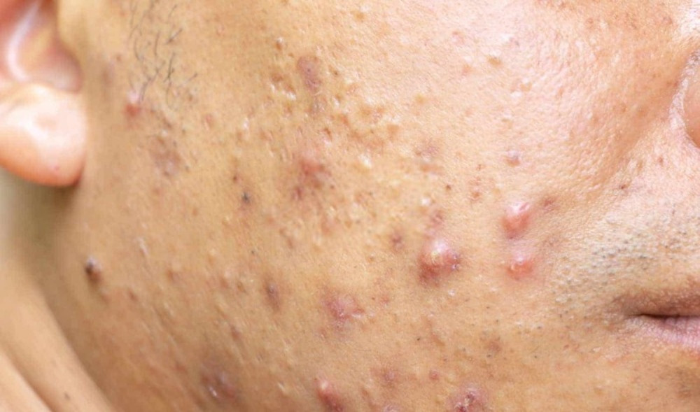 Mụn bọc có thể gây ra nhiều vấn đề tác hại cho làn da