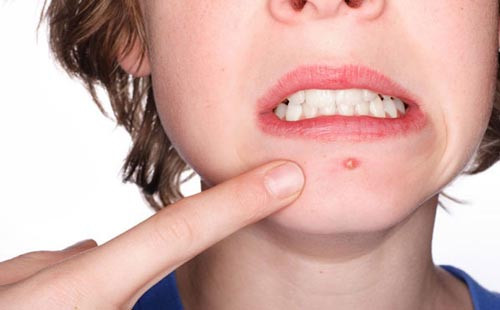 Cách Chăm Sóc Mụn Bọc Đúng Cách Để Tránh Tình Trạng Tái Phát