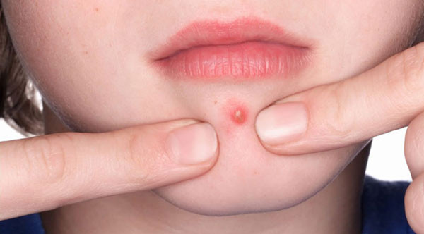 Hướng dẫn cách nặn mụn bằng cây nặn mụn an toàn tại nhà