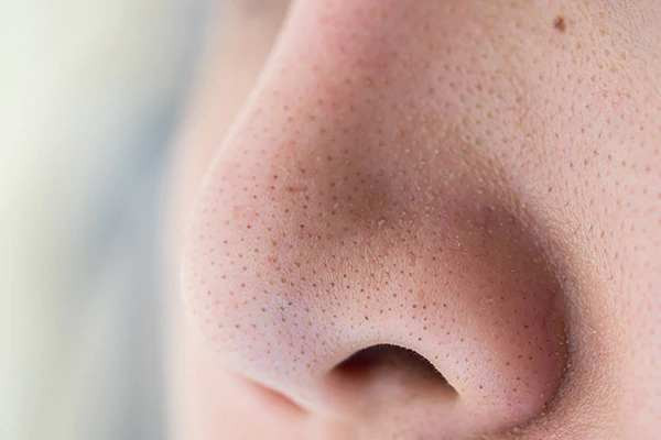 Mụn cám là gì? 5 cách điều trị mụn cám hiệu quả nhất