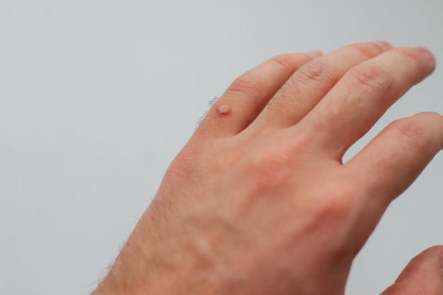 Mụn cóc là gì? 6 cách trị mụn cóc hiệu quả