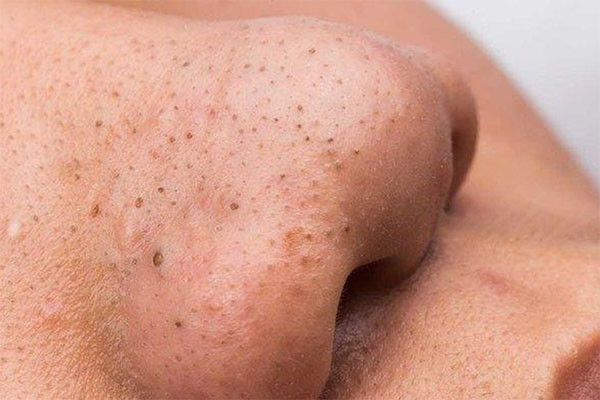 Mụn đầu đen: Nguyên nhân, Cách nhận biết và Phương pháp điều trị hiệu quả