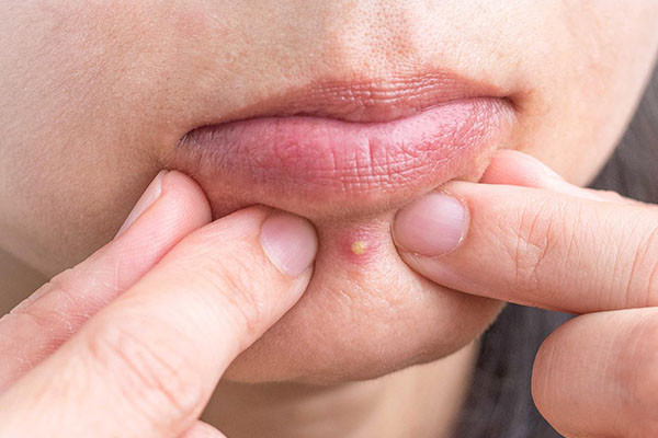 Cách Chăm Sóc Da Mụn Đầu Trắng Hiệu Quả Nhất