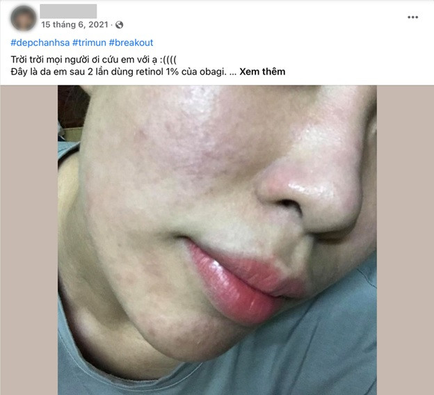 Mụn do kích ứng