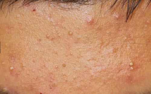Cách Điều Trị Mụn Mủ Cho Da Hiệu Quả Nhất