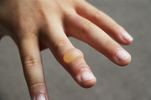 Mụn nước gây ra do bị bỏng