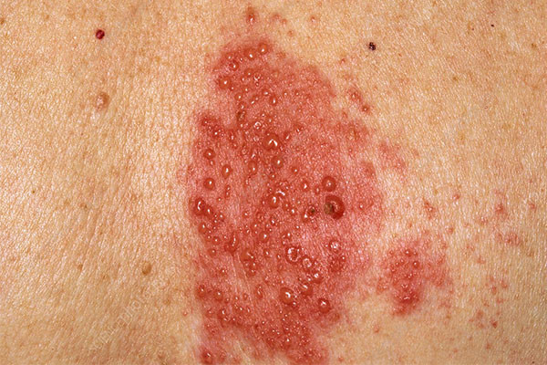 Mụn nước sinh dục gây ra bởi virus Herpes