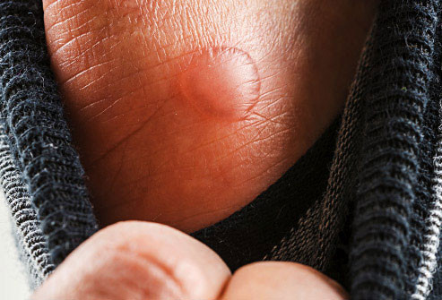 Tìm Hiểu Về Mụn Nước: Nguyên Nhân, Triệu Chứng Và Cách Điều Trị