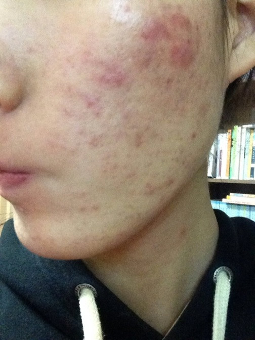 Mụn viêm nổi do Retinol Obagi
