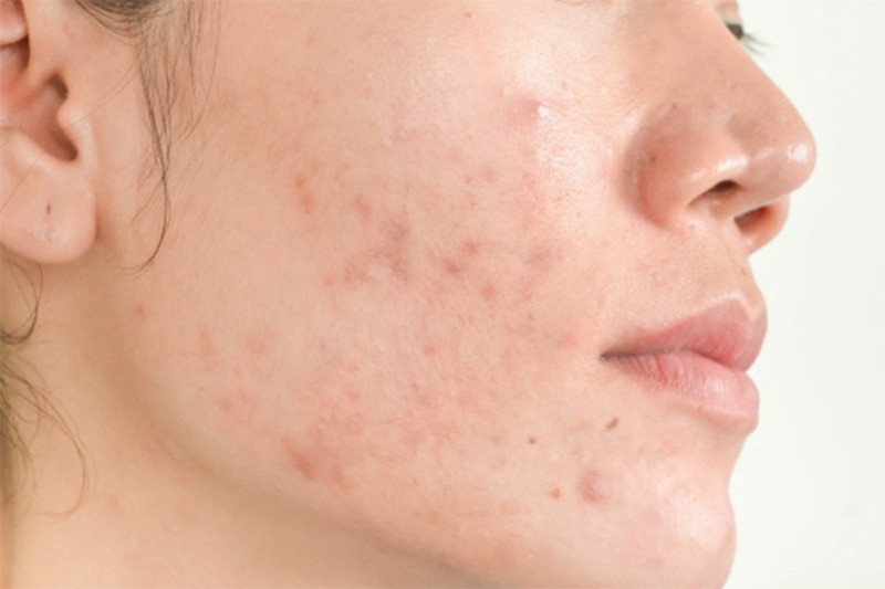 Nếu sử dụng các sản phẩm mỹ phẩm không phù hợp, làn da có thể bị kích ứng.