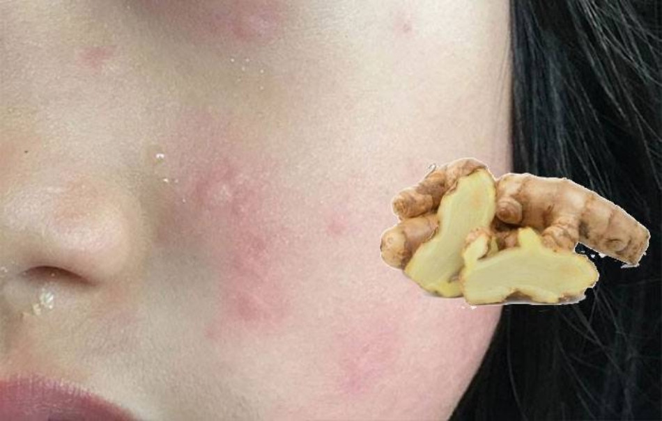 Nghệ Trắng Giúp Điều Trị Nhiễm Trùng Và Nám Da