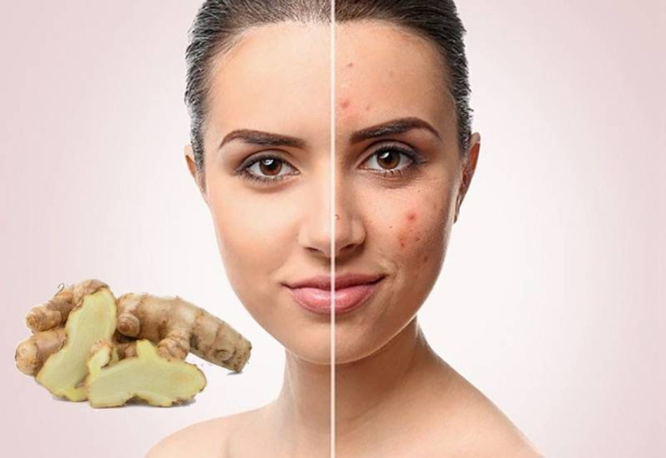 Nghệ Trắng Giúp Trị Mụn, Ngăn Ngừa Mụn Tái Phát