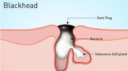 Nguyên nhân bị mụn đầu đen