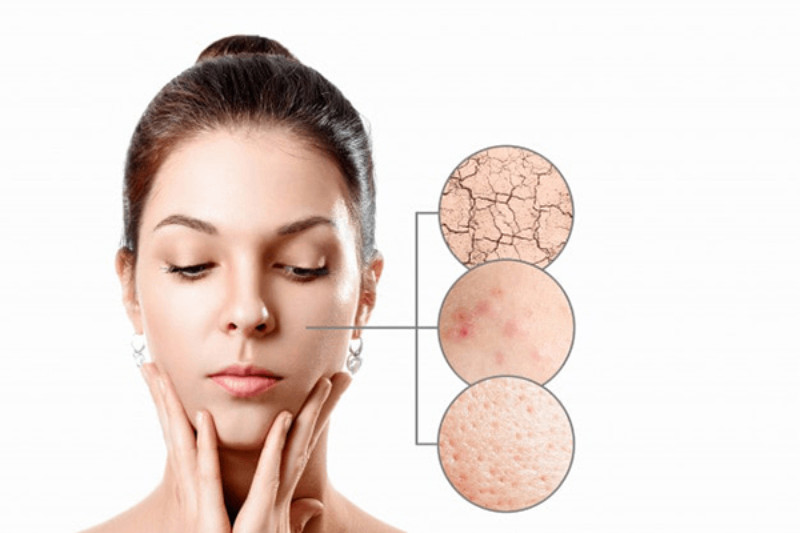 Nguyên nhân gây khô da và nổi mụn
