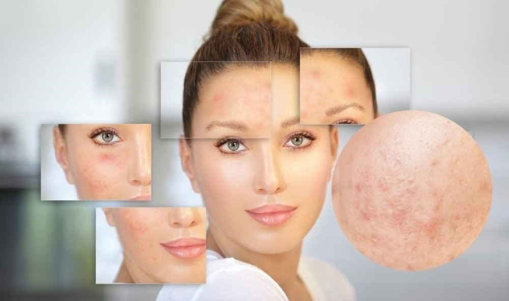 Nguyên nhân gây ra tình trạng mụn ẩn là gì?