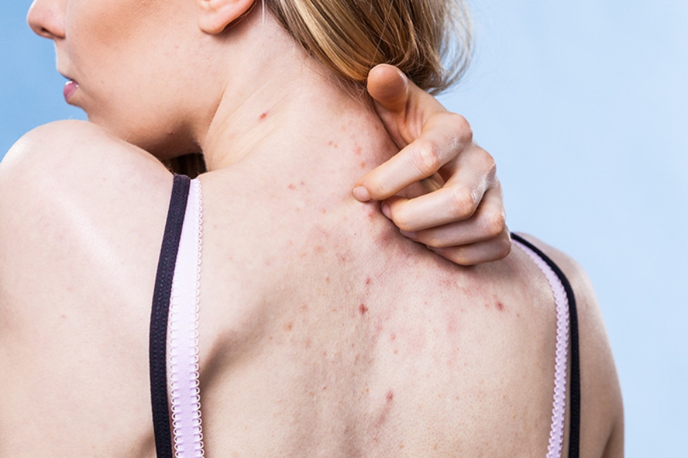 Cách chăm sóc da lưng bị mụn hiệu quả và ngăn ngừa tái phát
