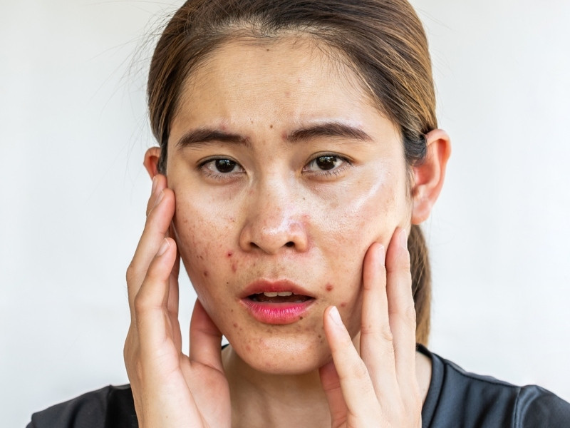 Nguyên nhân khiến da mặt bị dầu nhờn và nổi mụn