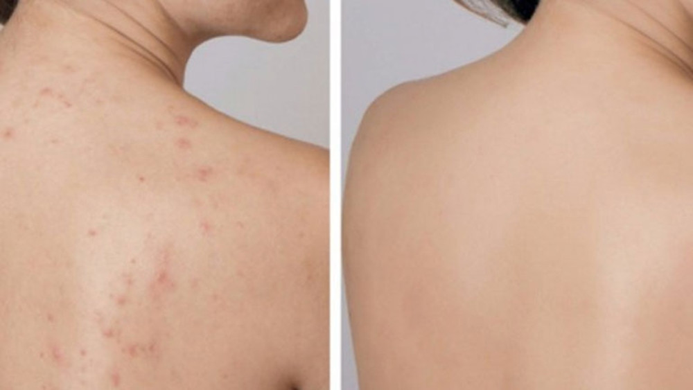 Những lưu ý chăm sóc da lưng