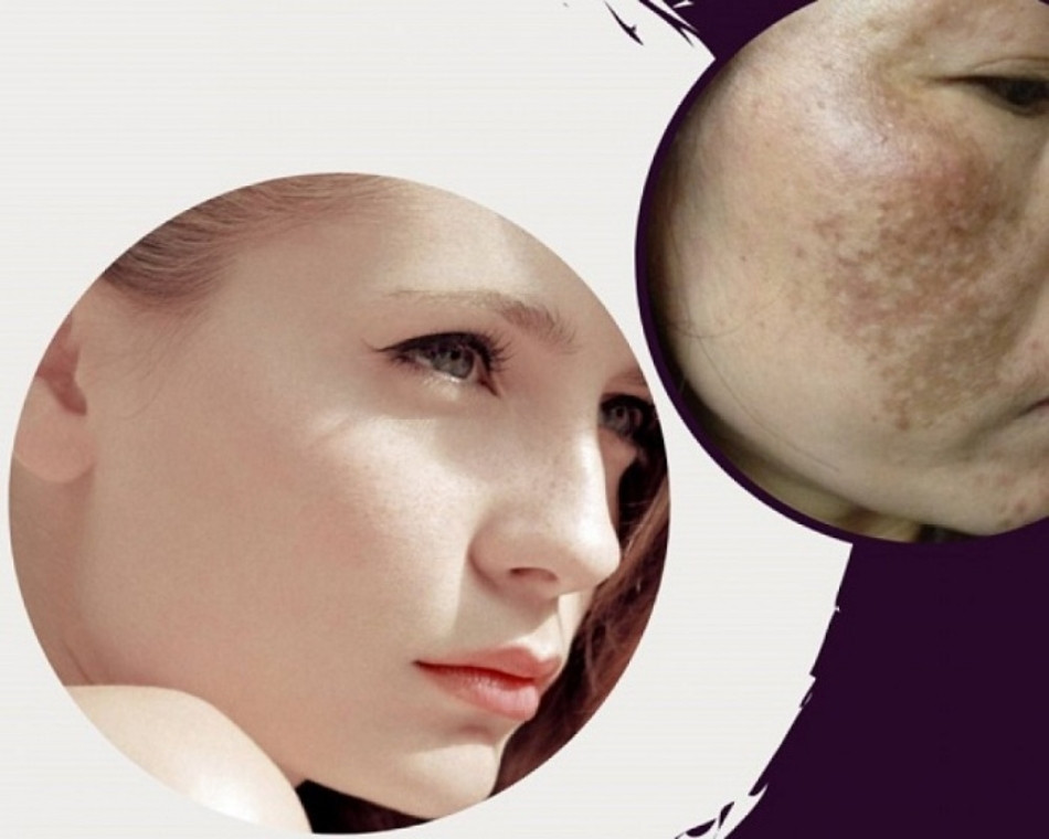 Những lưu ý để cải thiện và phòng ngừa nám chân đinh xuất hiện