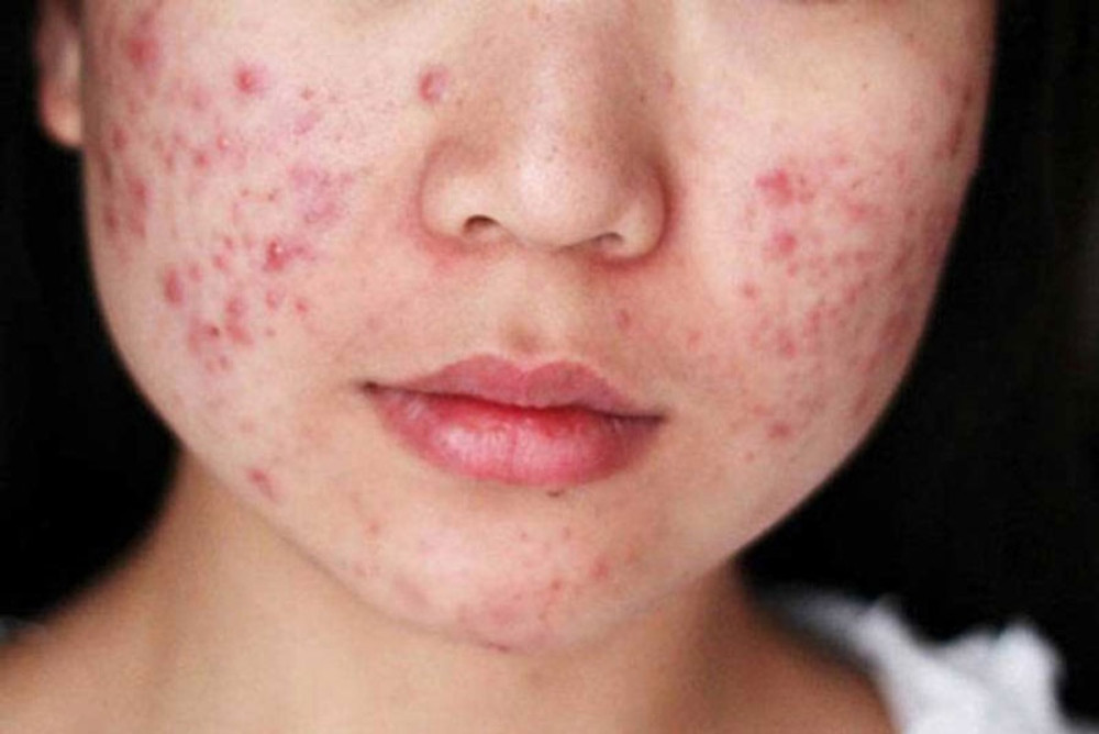 Những yếu tố khiến tình trạng mụn bọc càng trở nên trầm trọng