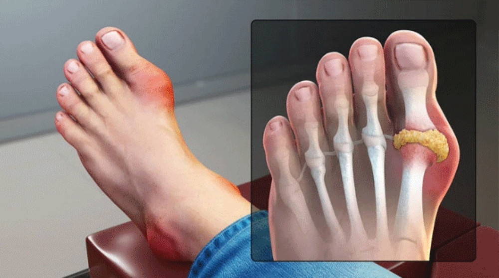 Nước gạo lứt rang và đậu đen ngăn ngừa bệnh gout