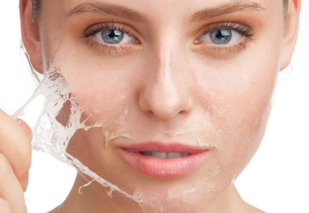 Peel da giúp hỗ trợ quá trình điều trị mụn ẩn hiệu quả